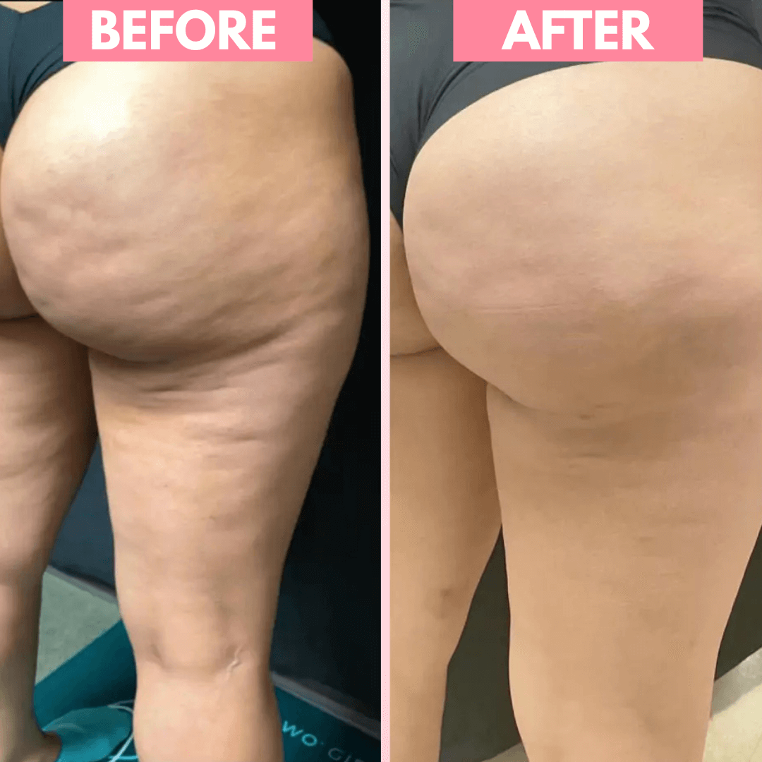 ByOlyra™ Cellulite Massager