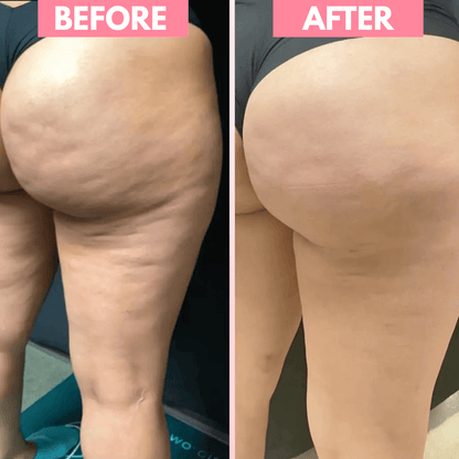 ByOlyra™ Cellulite Massager